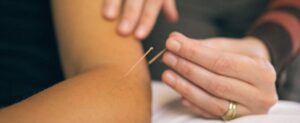 Acupuncturist providing treatment at White Rock 16 Ave Physiotherapy & Wellness Clinic